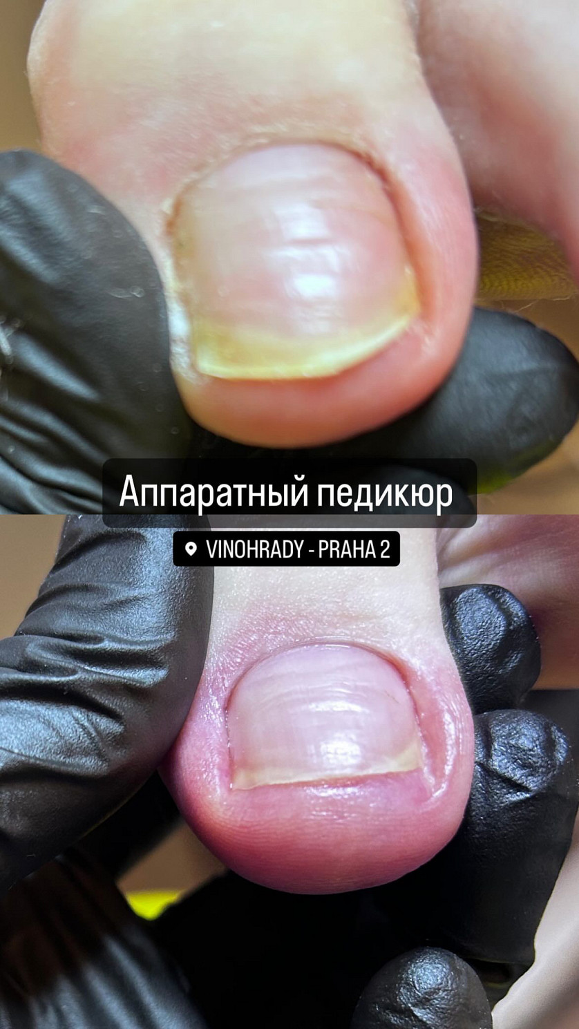 Аппаратный медицинский педикюр изображение 3