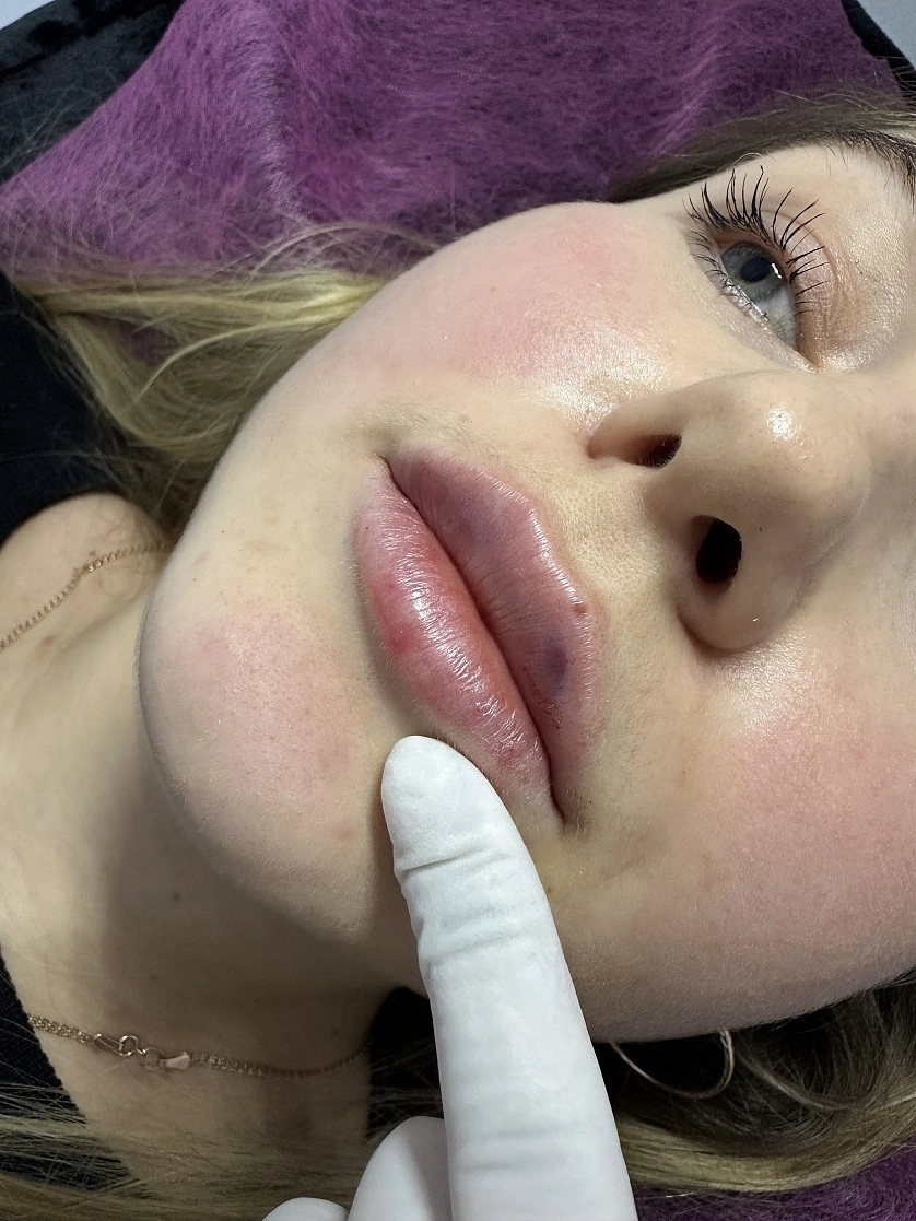 Práce v portfoliu - Контурная пластика губ