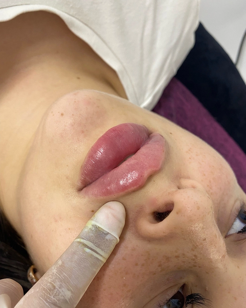 Práce v portfoliu - Контурная пластика губ - fotografie 3