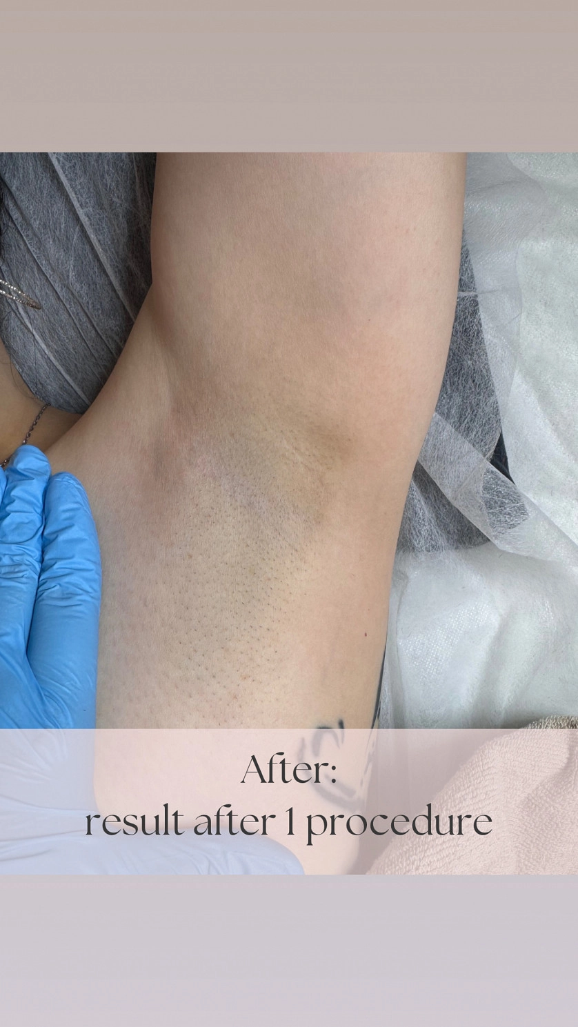 Práce v portfoliu - Лазерная Эпиляция - fotografie 3