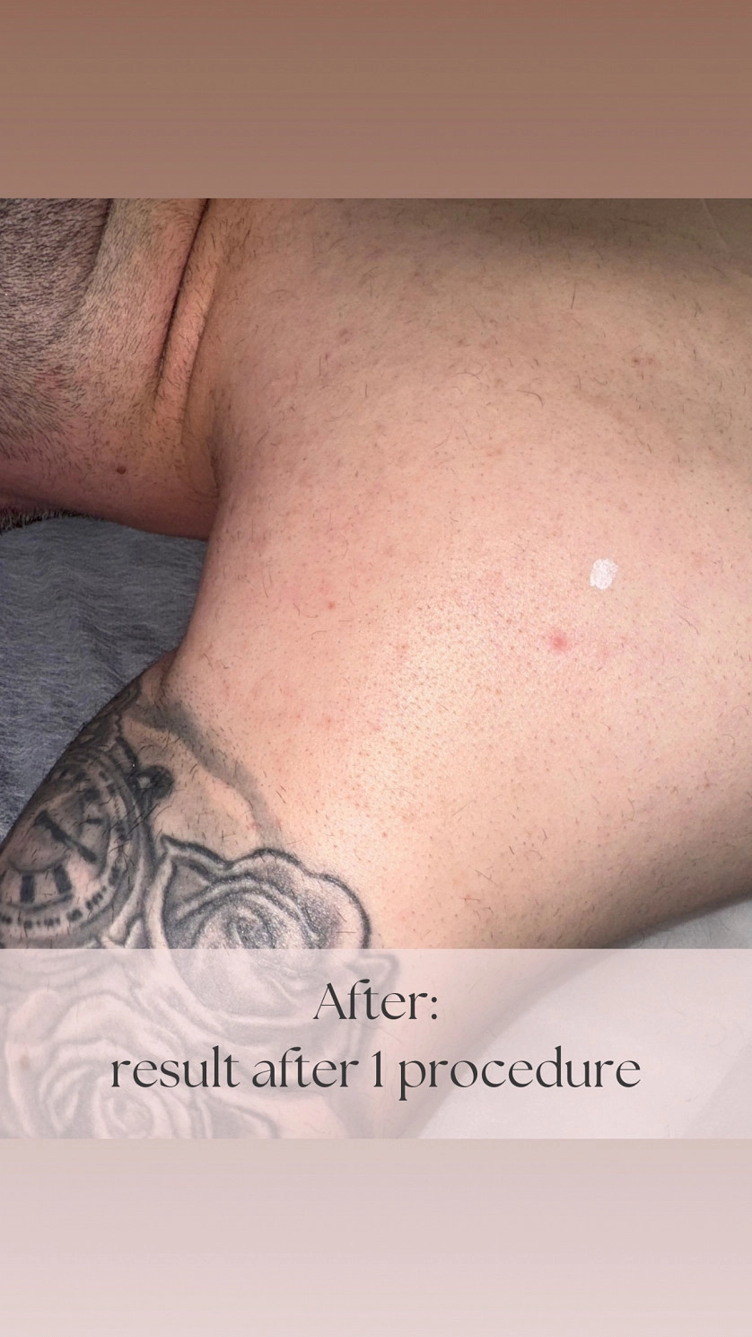 Práce v portfoliu - Лазерная Эпиляция - fotografie 5